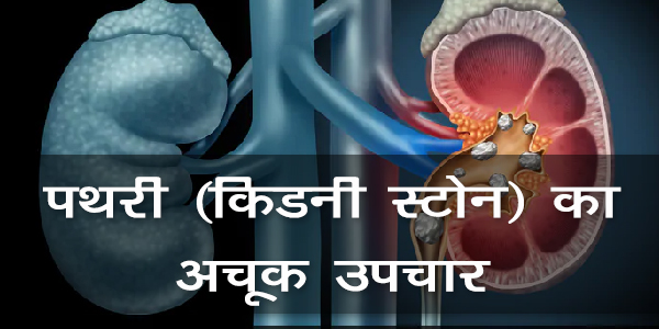 पथरी (किडनी स्टोन) का अचूक उपचार पथरी (किडनी स्टोन) का अचूक उपचार