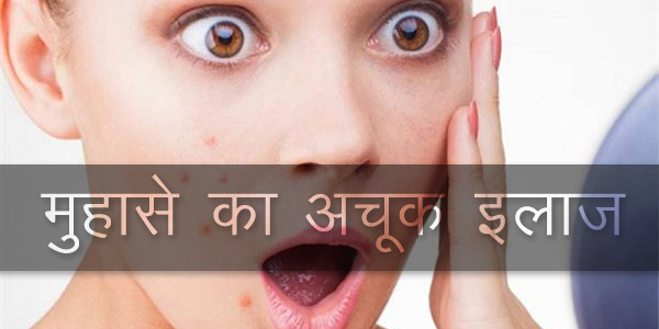 मुहाँसे (पिम्प्प्ल) का अचूक इलाज मुहाँसे (पिम्प्प्ल) का अचूक इलाज