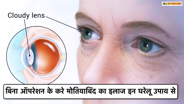 मोतिया बिन्द है तो करें ये घरेलु उपाय