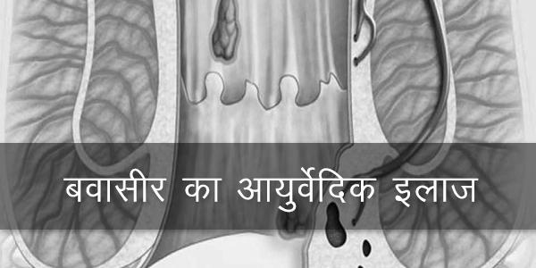 फिस्टुला या भगंदर, पाइल्स या बवासीर, किशमिश से बवासीर का इलाज, एलोवेरा से बवासीर का इलाज, हल्दी से बवासीर का इलाज इन हिंदी, केला से बवासीर का इलाज, पुरानी बवासीर का इलाज, फिटकरी से बवासीर का इलाज, बवासीर का होम्योपैथिक इलाज, बवासीर का अंग्रेजी दवा