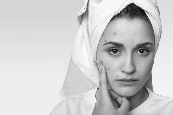 कील-मुँहासे (Acne) से छुटकारा पाने के घरेलू नुस्ख़े कील-मुँहासे (Acne) से छुटकारा पाने के घरेलू नुस्ख़े